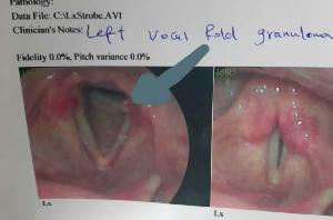 گرفتگی صدا، گرانولوم تارصوتی ، تشخیص و درمان 