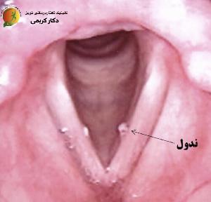 ندول تار صوتی