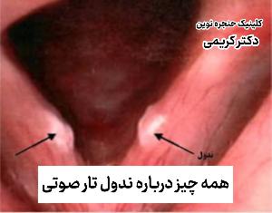 ندول تار صوتی چیست؟ علائم، علل و درمان آن