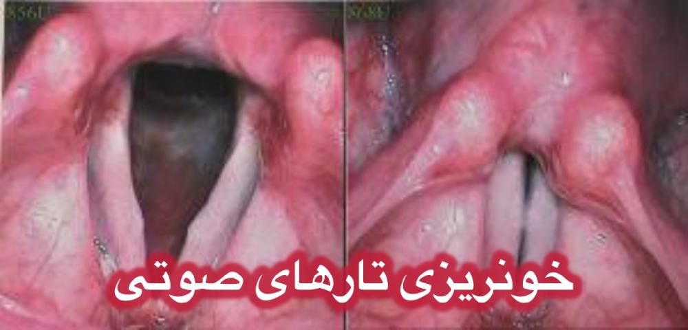خونریزی تارصوتی: