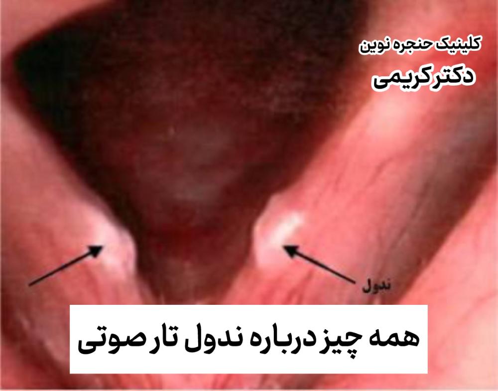 ندول تار صوتی چیست؟ علائم، علل و درمان آن